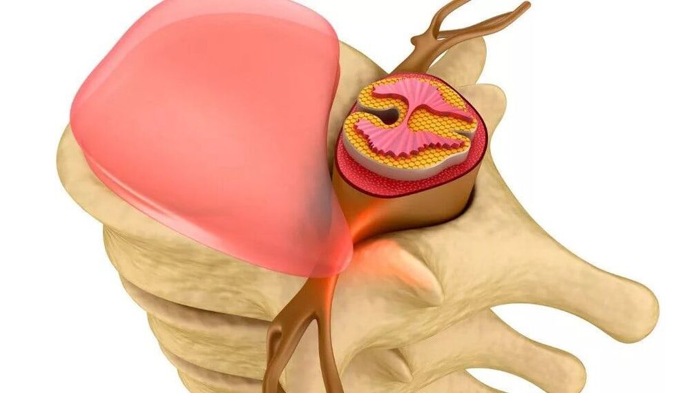 disminución de la potencia debido al cáncer
